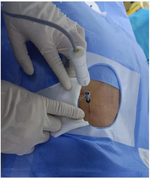 一针解决两段腰椎痛苦 哈医大四院骨科一病房低温等离子射频消融术治疗腰椎间盘突出