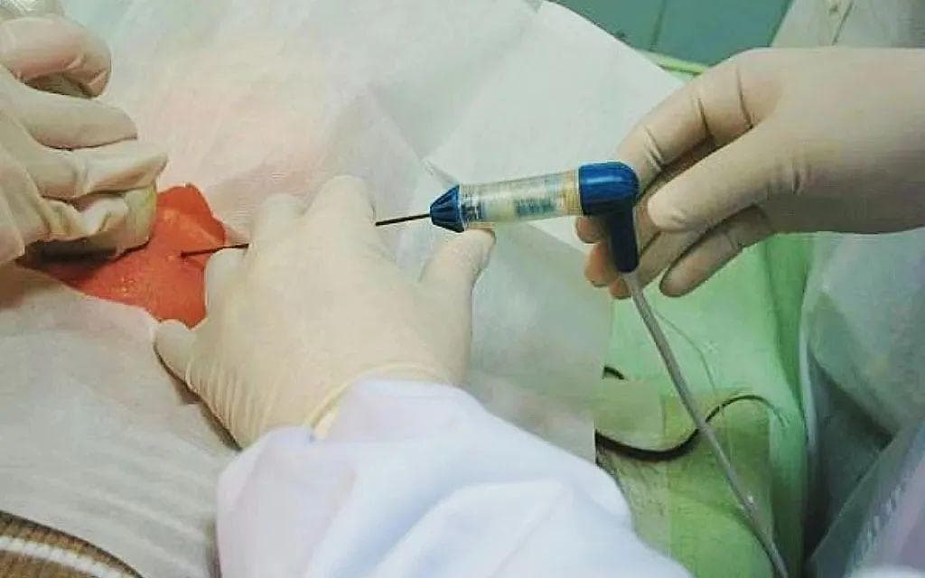 鉴别甲状腺结节首选方法——超声引导下甲状腺结节细针穿刺活检术