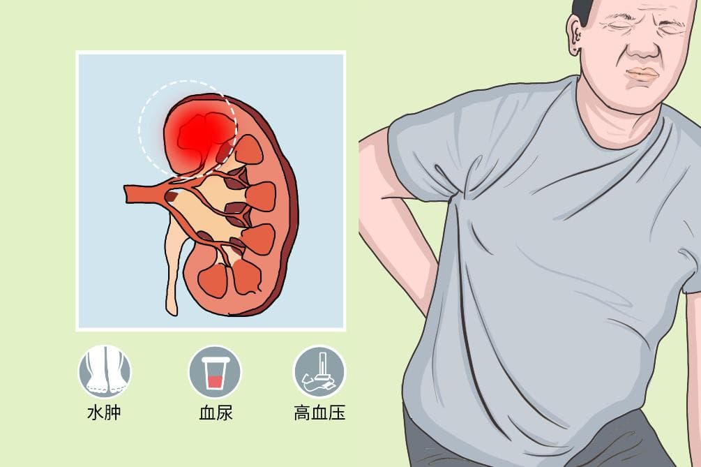 急性肾炎什么症状