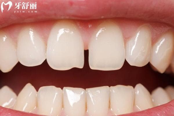 牙齿间隙变宽：是哪些因素在作祟？
