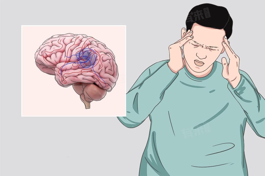脑血管畸形会遗传下一代吗