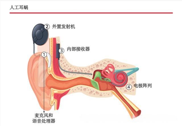 科技助听生活——听力重建的黑科技