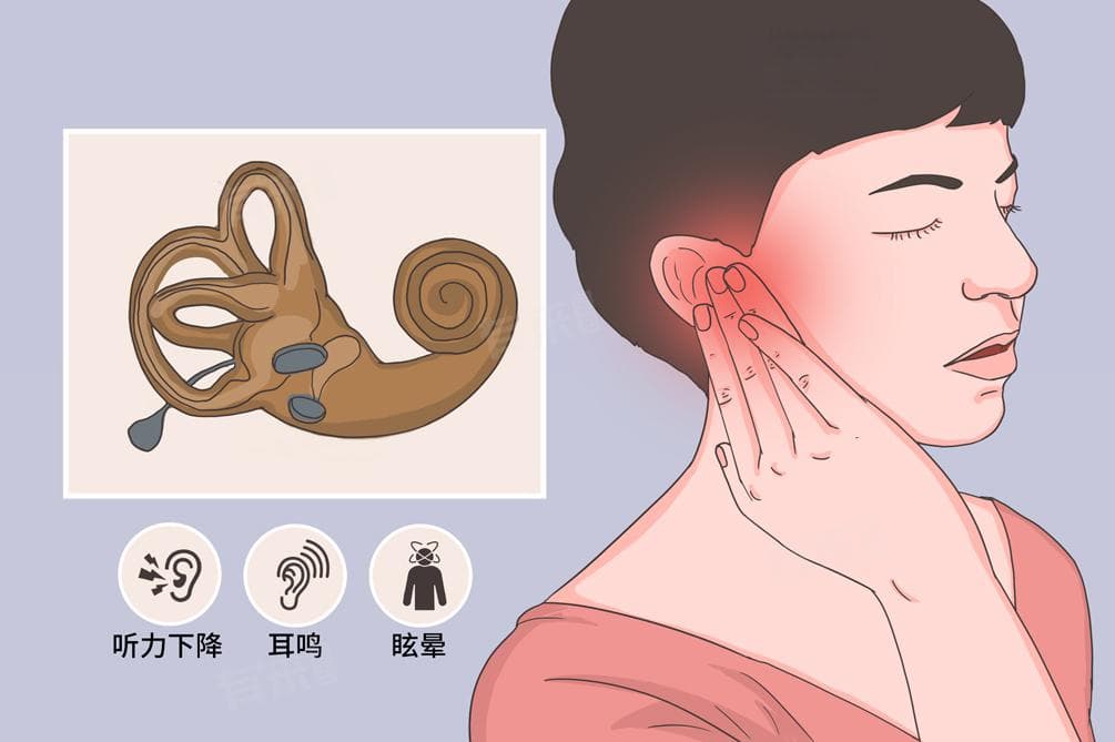 美尔氏眩晕综合征是什么病，能治愈吗