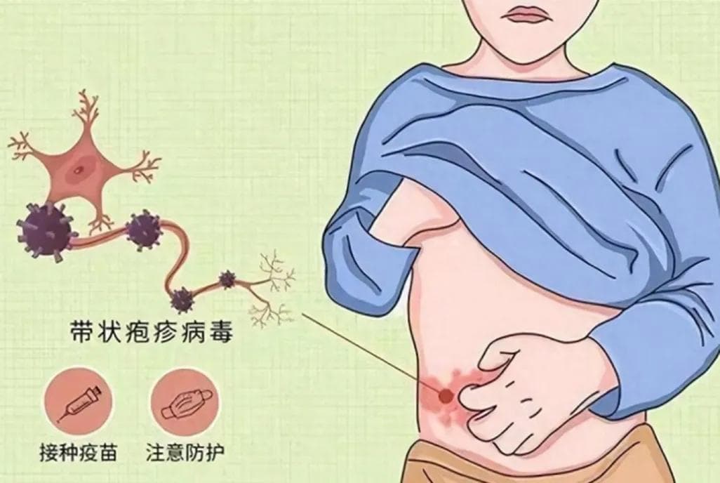带状疱疹不仅痛在皮肤，还伤在心理：中医特色疗法助力身心康复