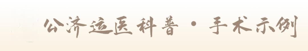 手术示例-膝｜膝关节置换术