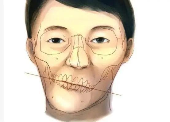 骨性偏颌到底是什么？是否需要进行正颌手术？