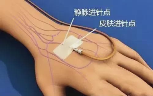 打针还在靠手感？学会这4个方法，提升穿刺成功率！