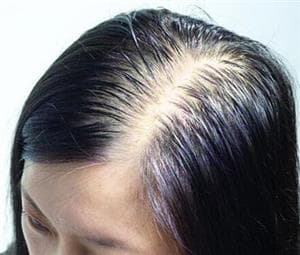 治疗男性脱发要找准时机