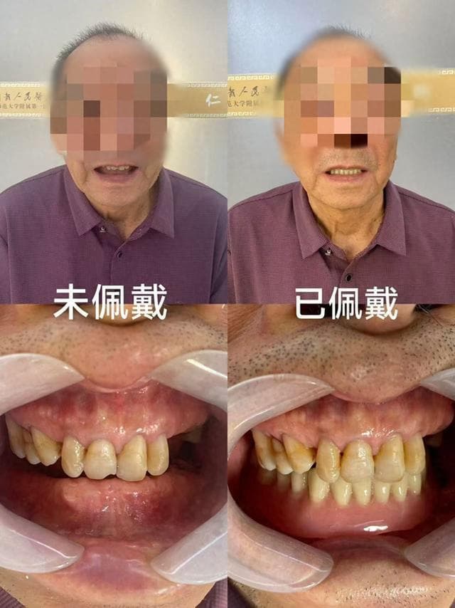 “即刻”还你一口好牙！吸附性义齿让“无牙”老人咬苹果不是梦