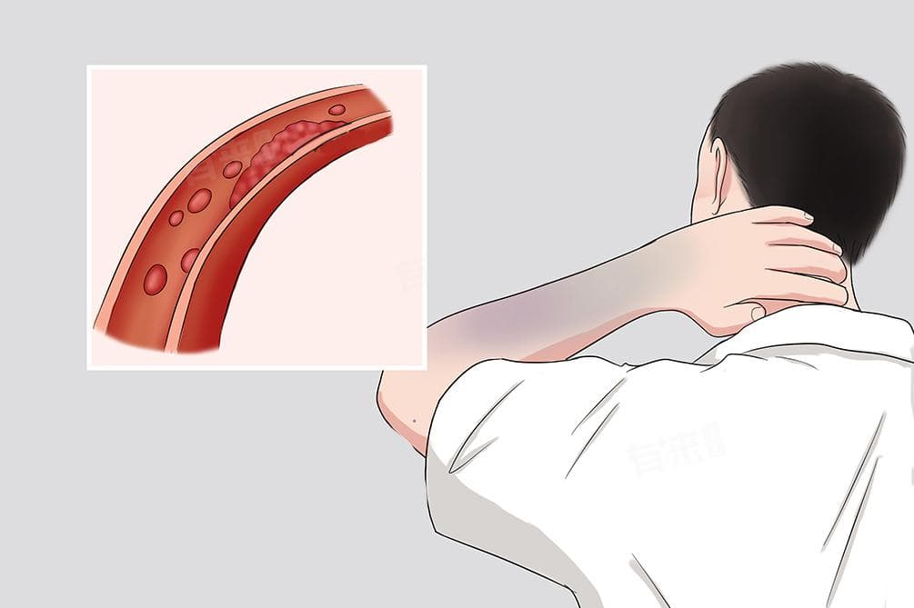 D-二聚体正常值及临床意义
