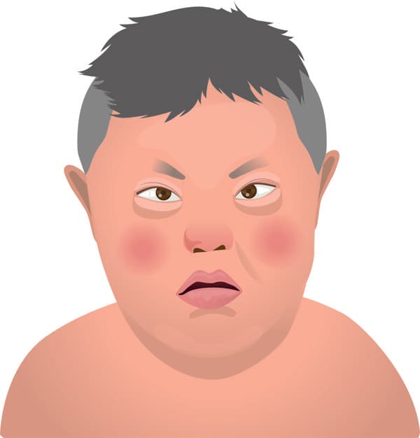 麻腮风的主要症状、诊断与治疗