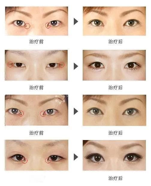 中医视角解析痘痘成因与调理方法
