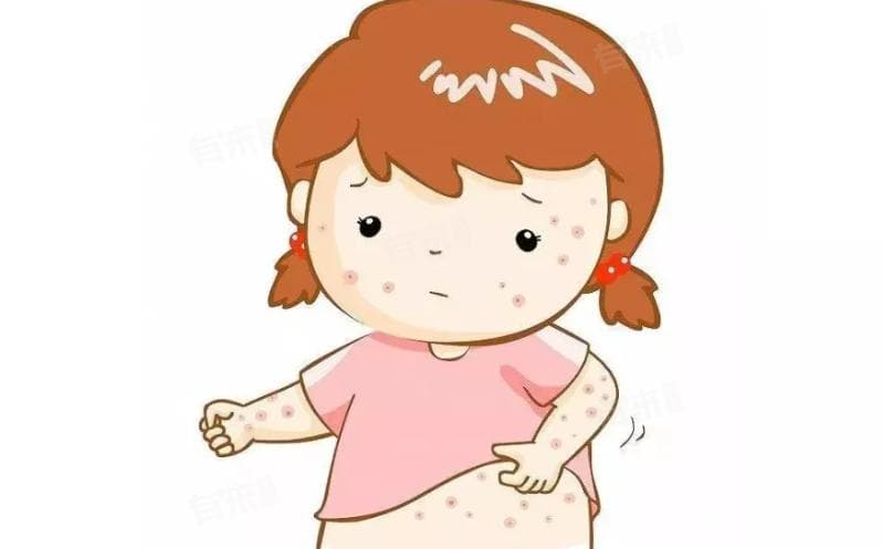 热性荨麻疹的四种治疗方法