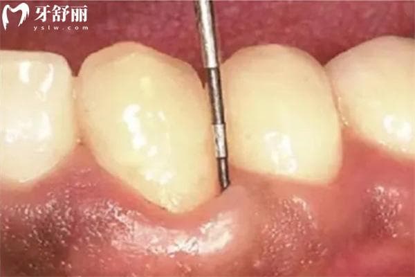 牙周袋长什么样子？深度分级带你了解牙周袋是什么？