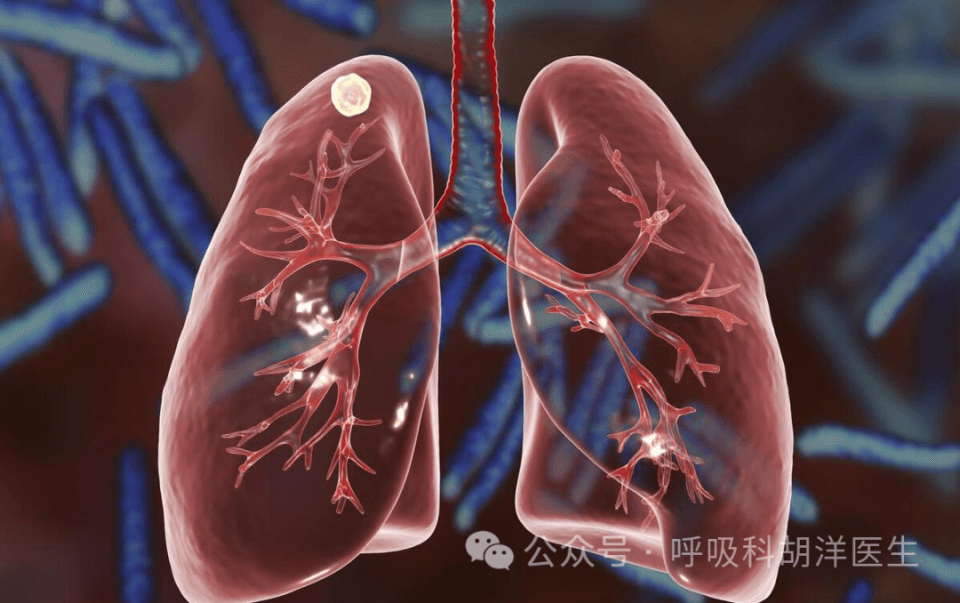 科兴疫苗停产，疫苗会引起肺部结节吗？为什么那么多人查出肺结节