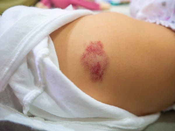 婴儿血管瘤颜色变深了怎么回事