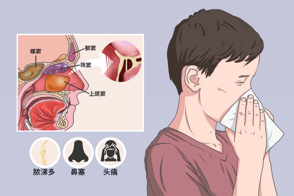 鼻窦炎的最明显症状
