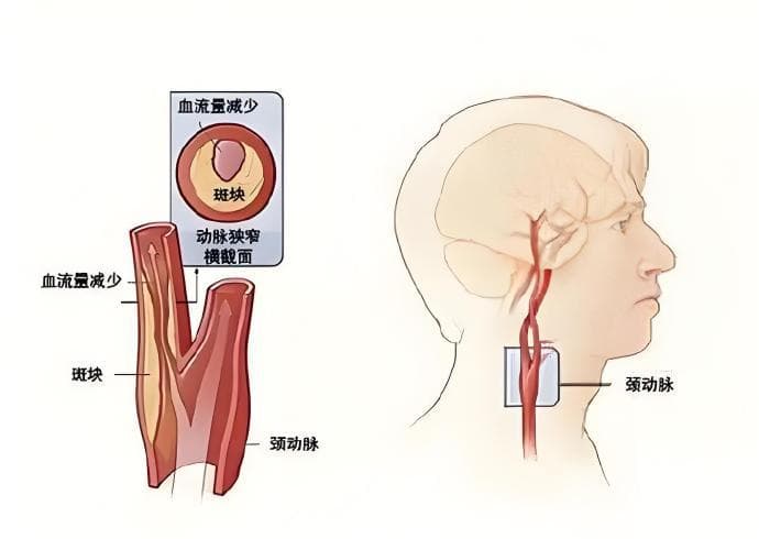 如何预防和应对颈动脉斑块？