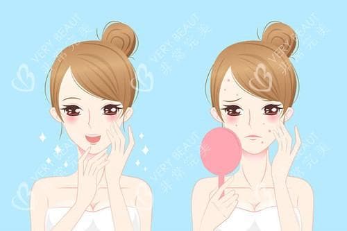 TCA去痘坑效果如何？需要几次治疗？维持多久？