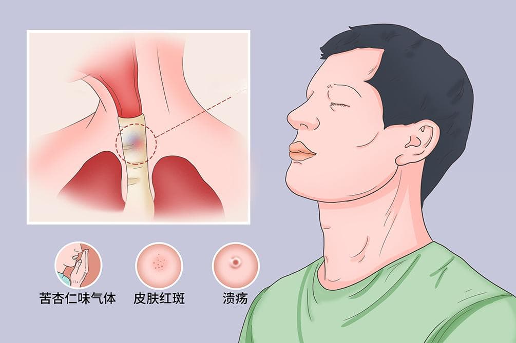 氰化物中毒解毒
