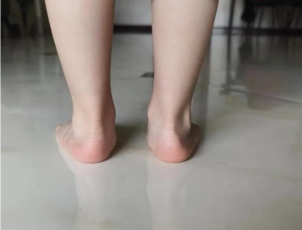 儿童出现脚后跟疼痛是怎么回事？需要治疗吗？