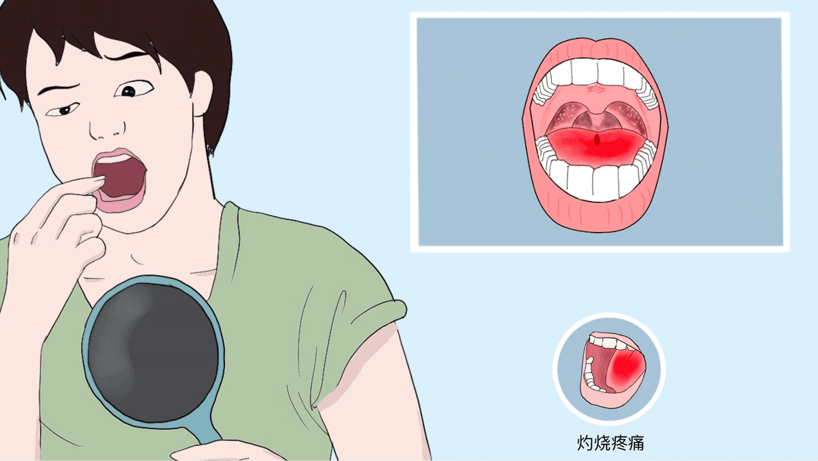 灼口综合征：口舌烧灼感的困扰与应对之道