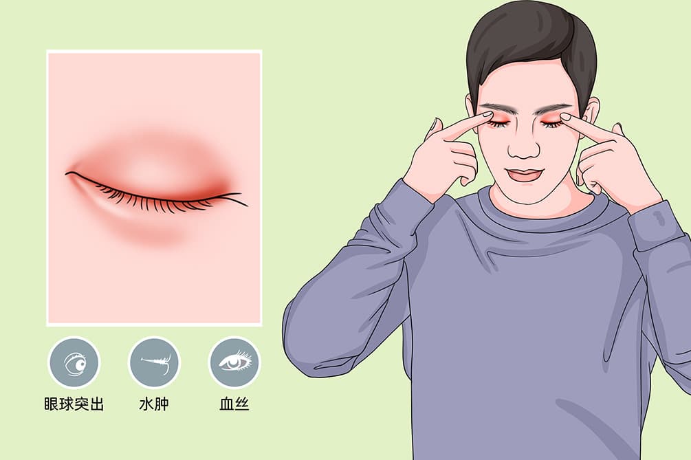 眼压高会自己降下来吗