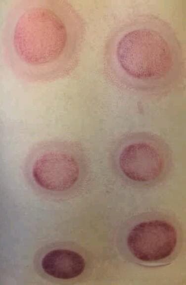拔罐的好处：传统疗法的健康奥秘