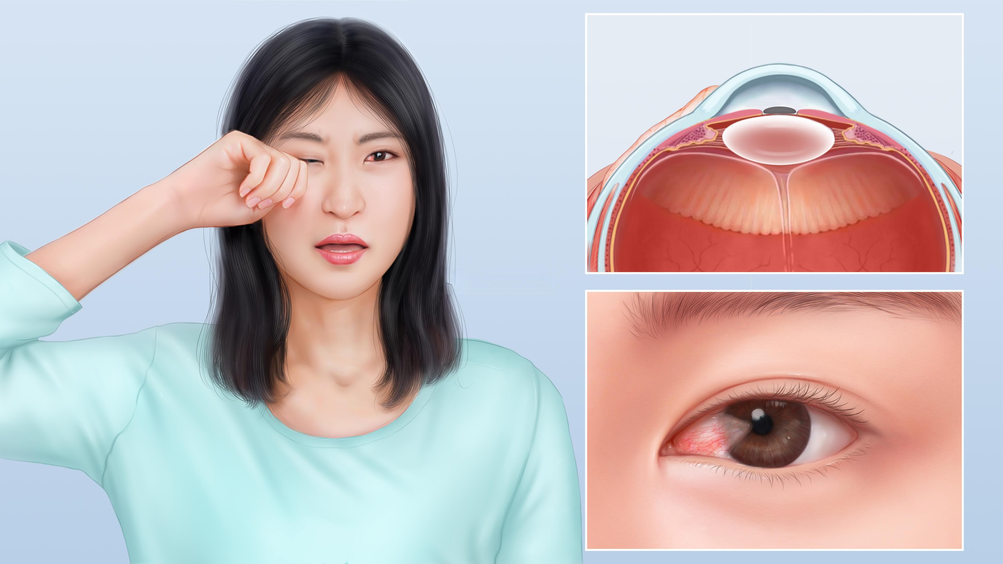翼状胬肉：常见眼表疾病，可手术治疗但易复发