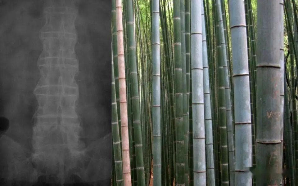 强直性脊柱炎：从病因到康复，全面解析
