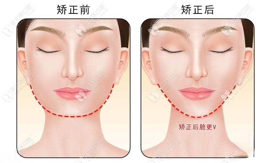 做完牙齿矫正后脸垮了还能恢复吗？别担心，真实经历说能恢复