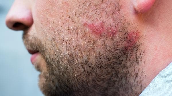 痤疮和毛囊炎的区别：病因、症状、治疗和预防全解析