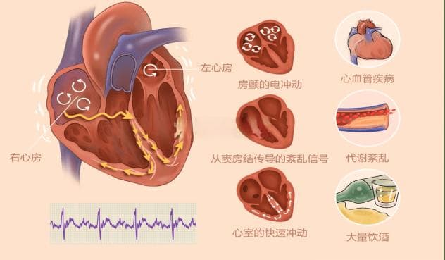 【医学科普】心房颤动的危害与应对