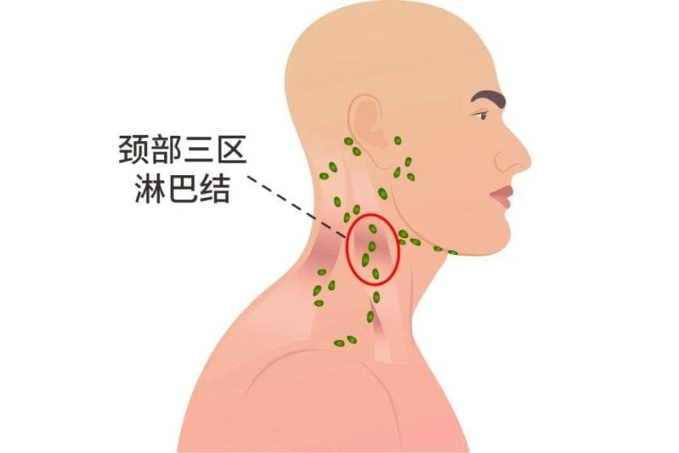 淋巴结肿大，为什么疼比不疼更“安全”