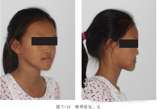 为什么孩子会出现地包天？早期矫正如何干预？