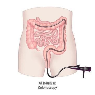 肠镜检查后的注意事项：腹胀处理与息肉切除护理