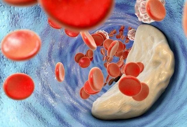 低密度脂蛋白高，怎么才能降下来？医生：3个实用方法，供你参考
