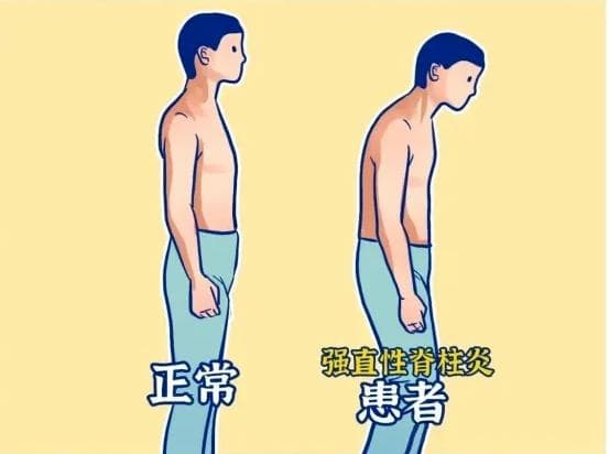 强直性脊柱炎的治疗原则——八不原则