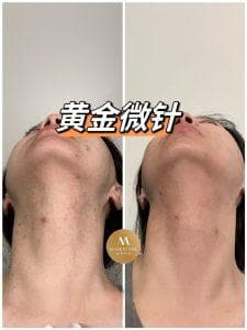 黄金微针 Infini射频，读懂这一篇就够啦！