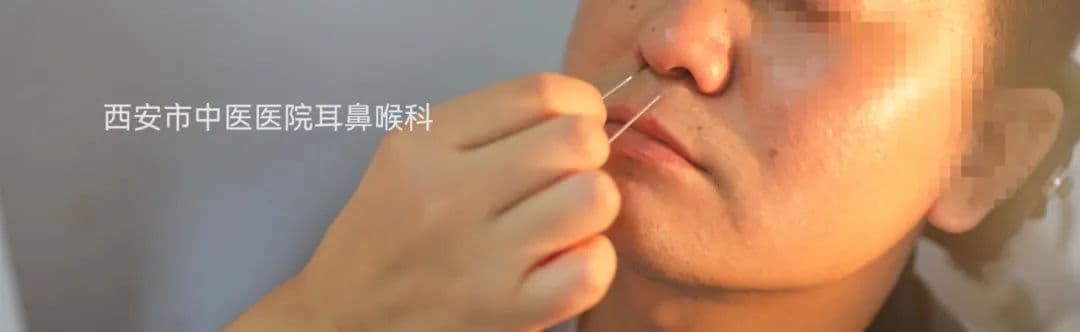 全国爱鼻日丨浅谈常见而有效的鼻病中医外治法