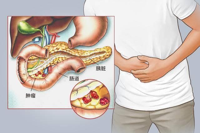 甜食与胰腺癌：科学解读甜食对胰腺的影响