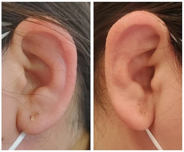 打完耳洞耳朵又红又痒？皮肤科医生教你正确处理外伤性湿疹
