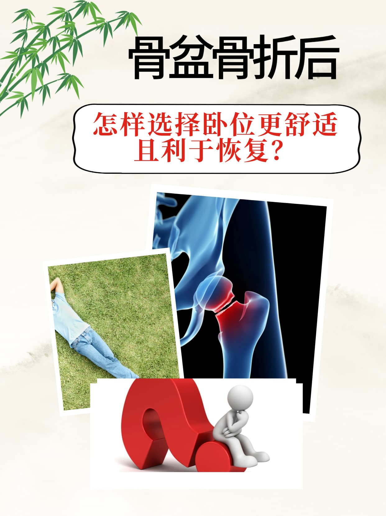 骨盆骨折后，怎样选择卧位更舒适且利于恢复？