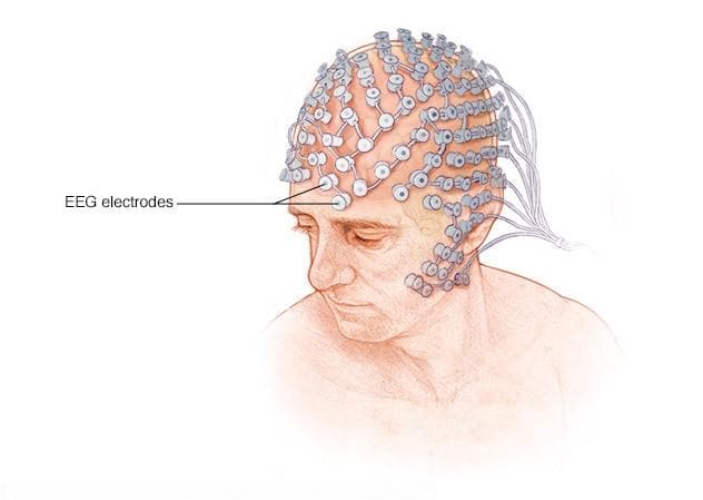 脑电图（EEG）检查详解