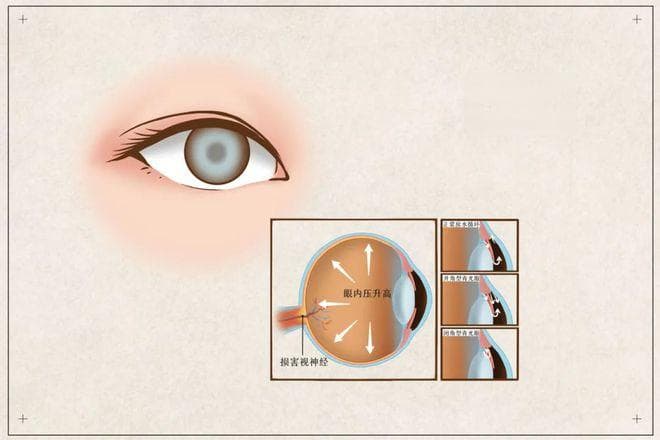 为eye筑牢 “防护墙”，守护清晰视界丨世界青光眼日