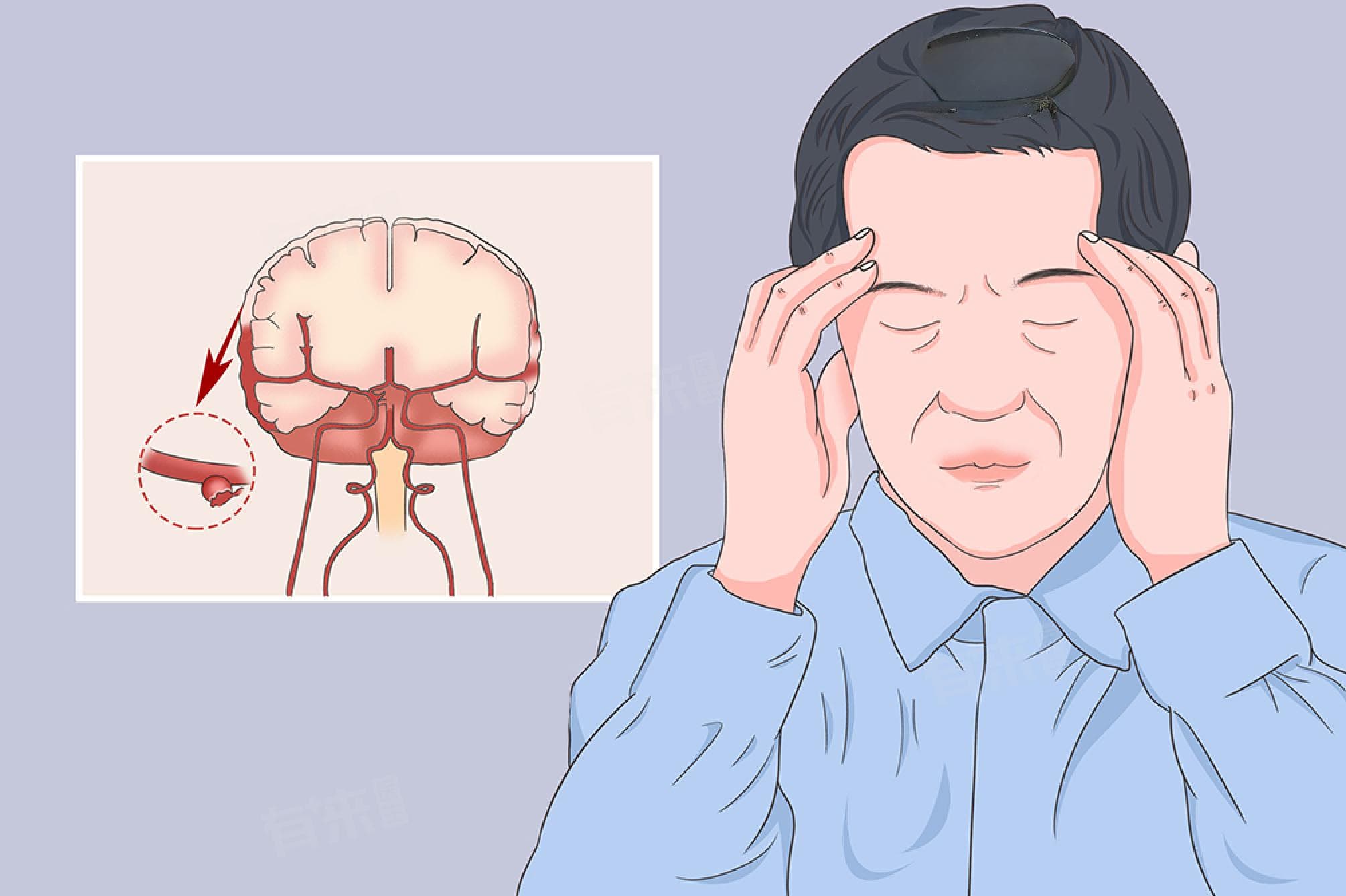 蛛网膜下腔少量出血怎么治疗