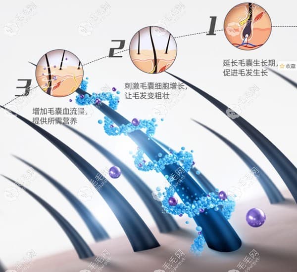 米诺地尔酊生发液哪种效果好？液体好还是凝胶泡沫好
