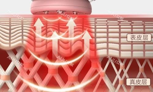 超光子嫩肤的功效与副作用：全面解析这项美容技术的优劣