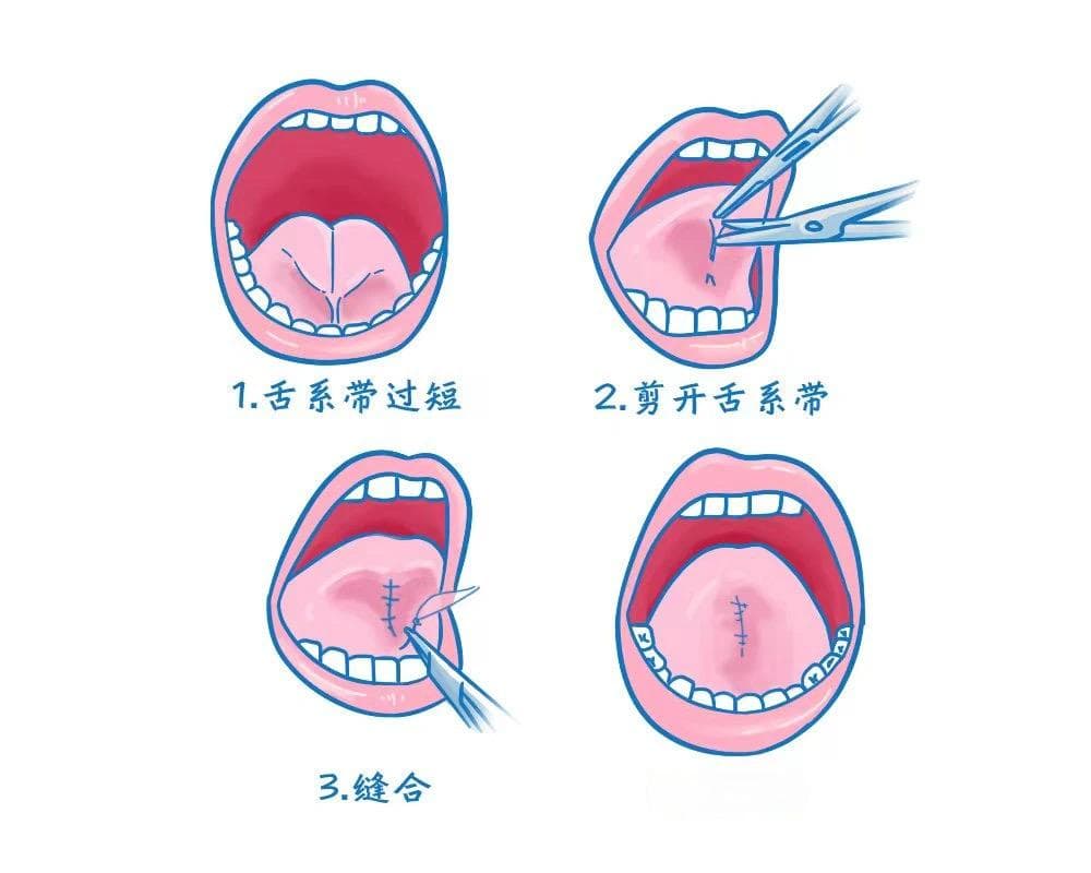 专家解读：婴儿舌系带手术并非“一刀切”