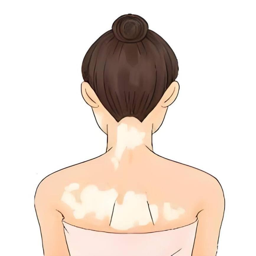揭秘白癜风饮食禁忌：科学忌口，助力肌肤重焕光彩